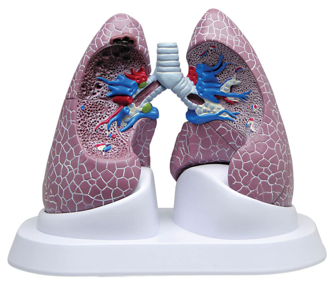 Lung Set With Pathologies
