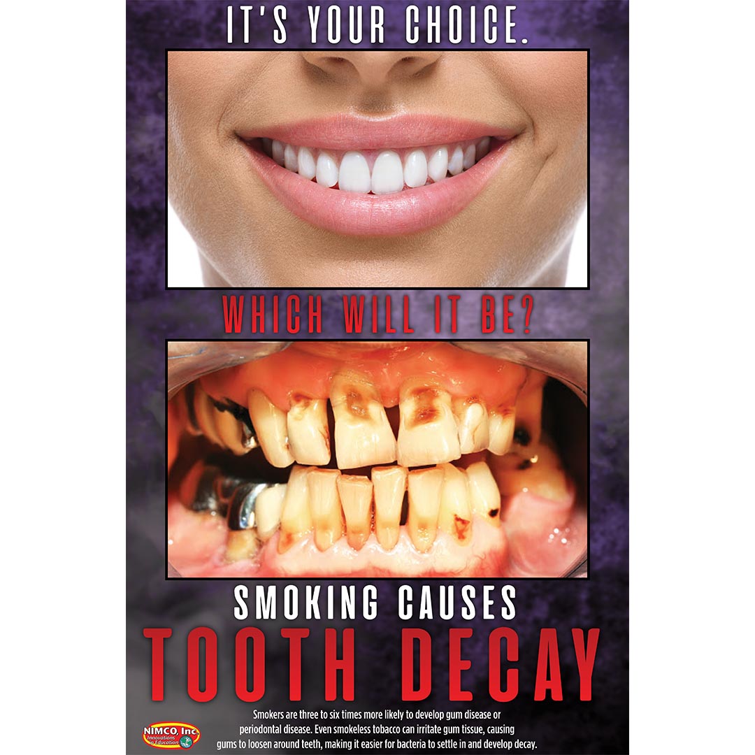 Tooth Decay Poster