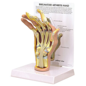 Rheumatoid Arthritis Hand Model