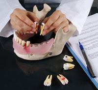 Dental Disease Model, 21 Parts