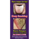 Hairy Tongue Poster