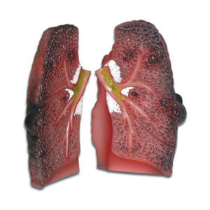 Cough Up A Lung Model