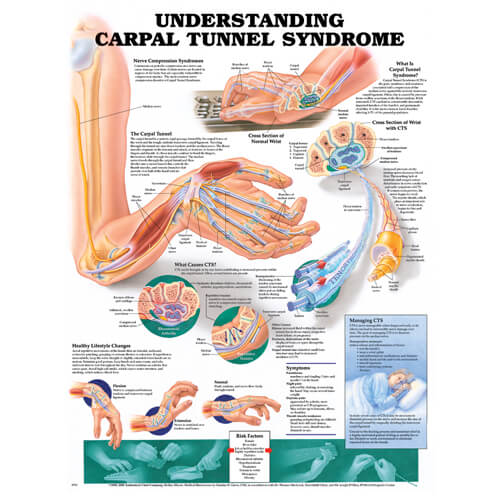 Understanding Carpal Tunnel Syndrome (Laminated)