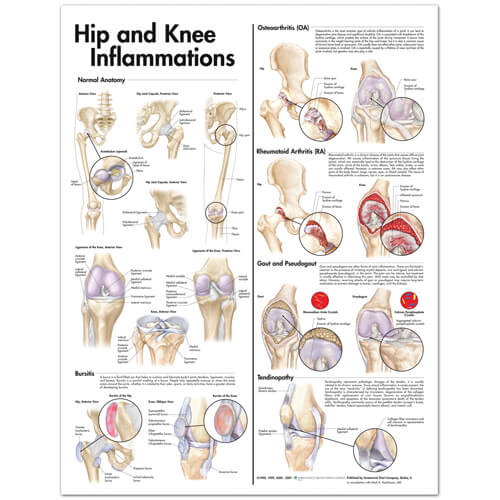 Hip and Knee Inflammations (Laminated)