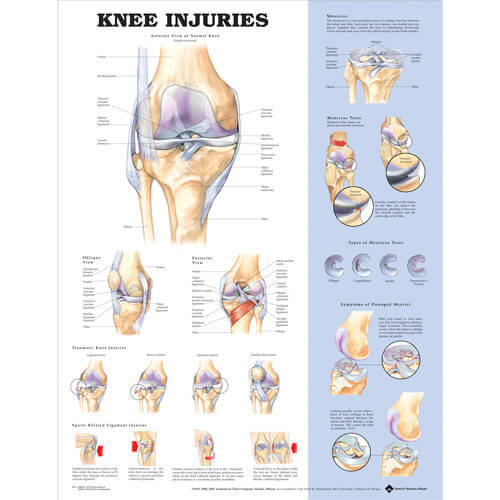 Knee Injuries Poster