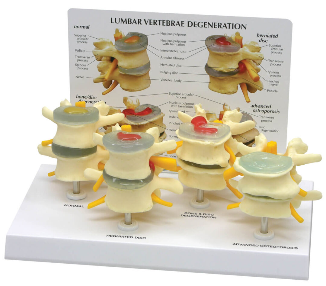 4-Stage Vertebrae Model