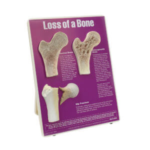 Loss Of A Bone Easel Display