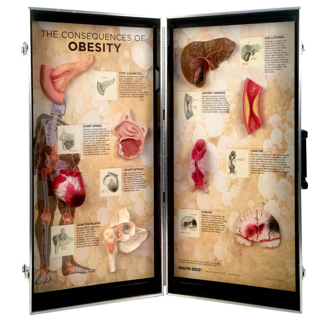Obesity Consequences 3-D Display