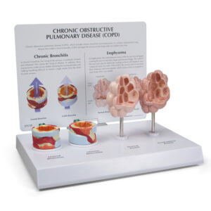 COPD MODEL