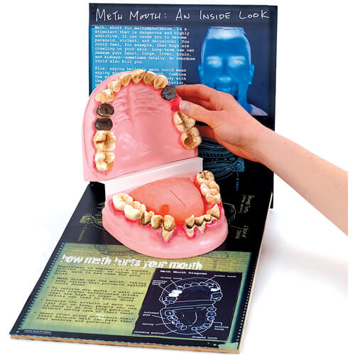 Meth Mouth: An Inside Look Meth Mouth: An Inside Look
