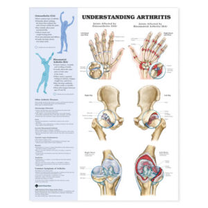Understanding Arthritis (Laminated)