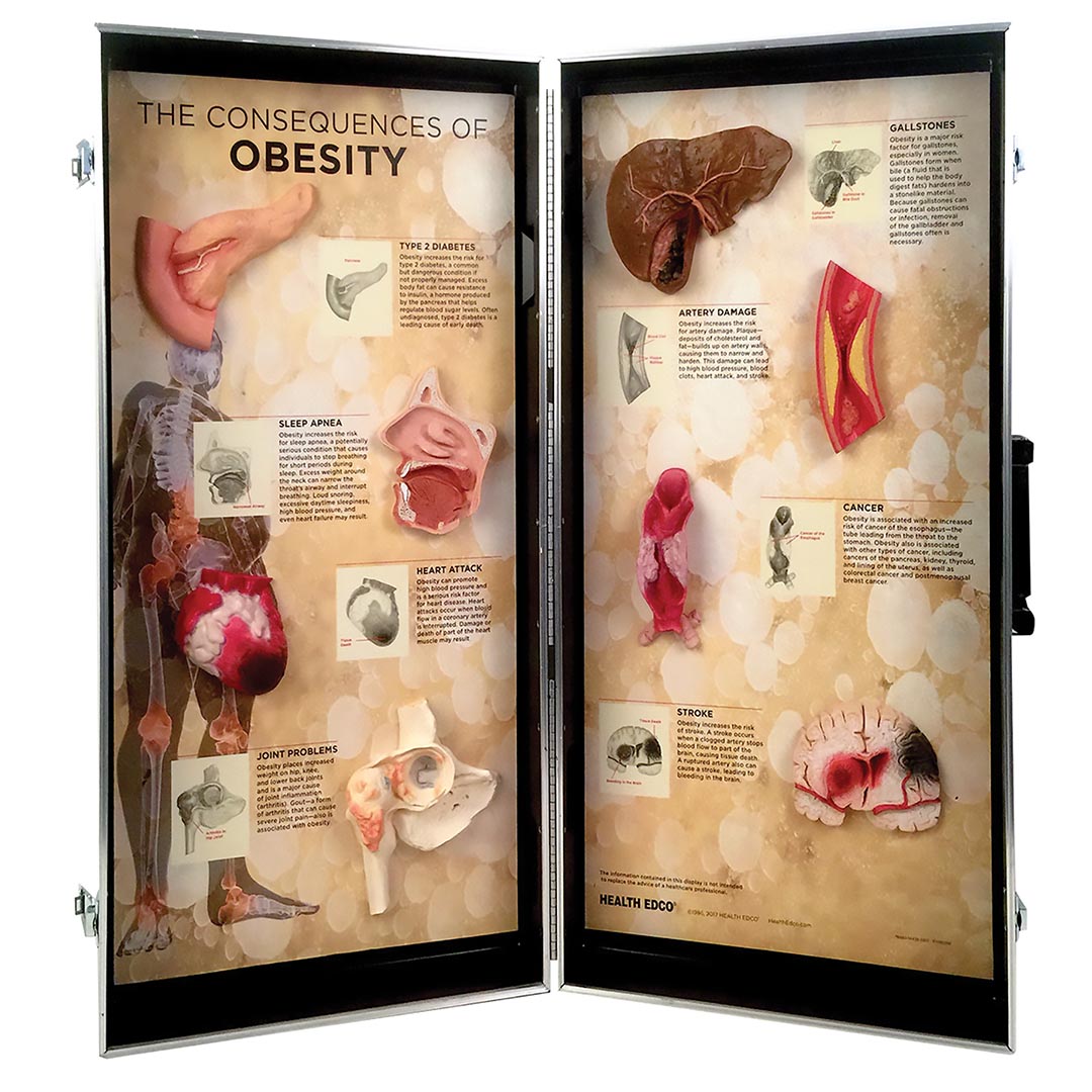 Obesity Consequences 3-D Display