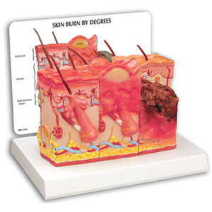 Skin Burn and Normal