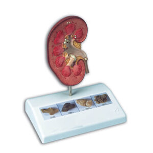 Kidney Stone (Model)