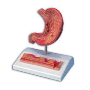 Stomach with Ulcers Model